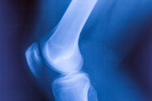 Röntgenaufnahme des Knies